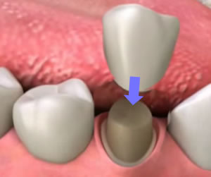 Link to more info about Porcelain Crowns