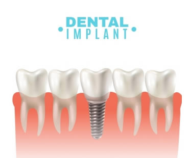 Private: How Dental Implants Can Preserve Bone