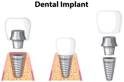 Small but Mighty: When Mini Dental Implants are the Right Choice for You