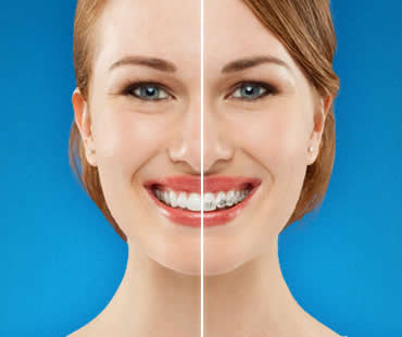 Why Adults Should Choose Invisalign to Straighten Teeth