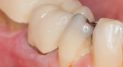 Tips about Receding Gums